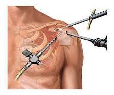 Cirurgia Artroscopia para Manguito Rotador