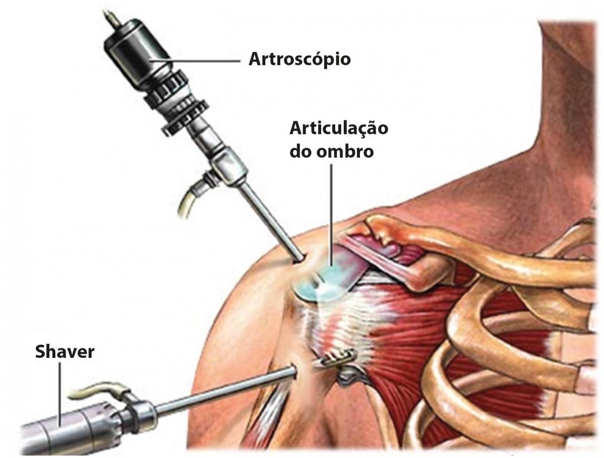 Cirurgia artroscópica no ombro - 1