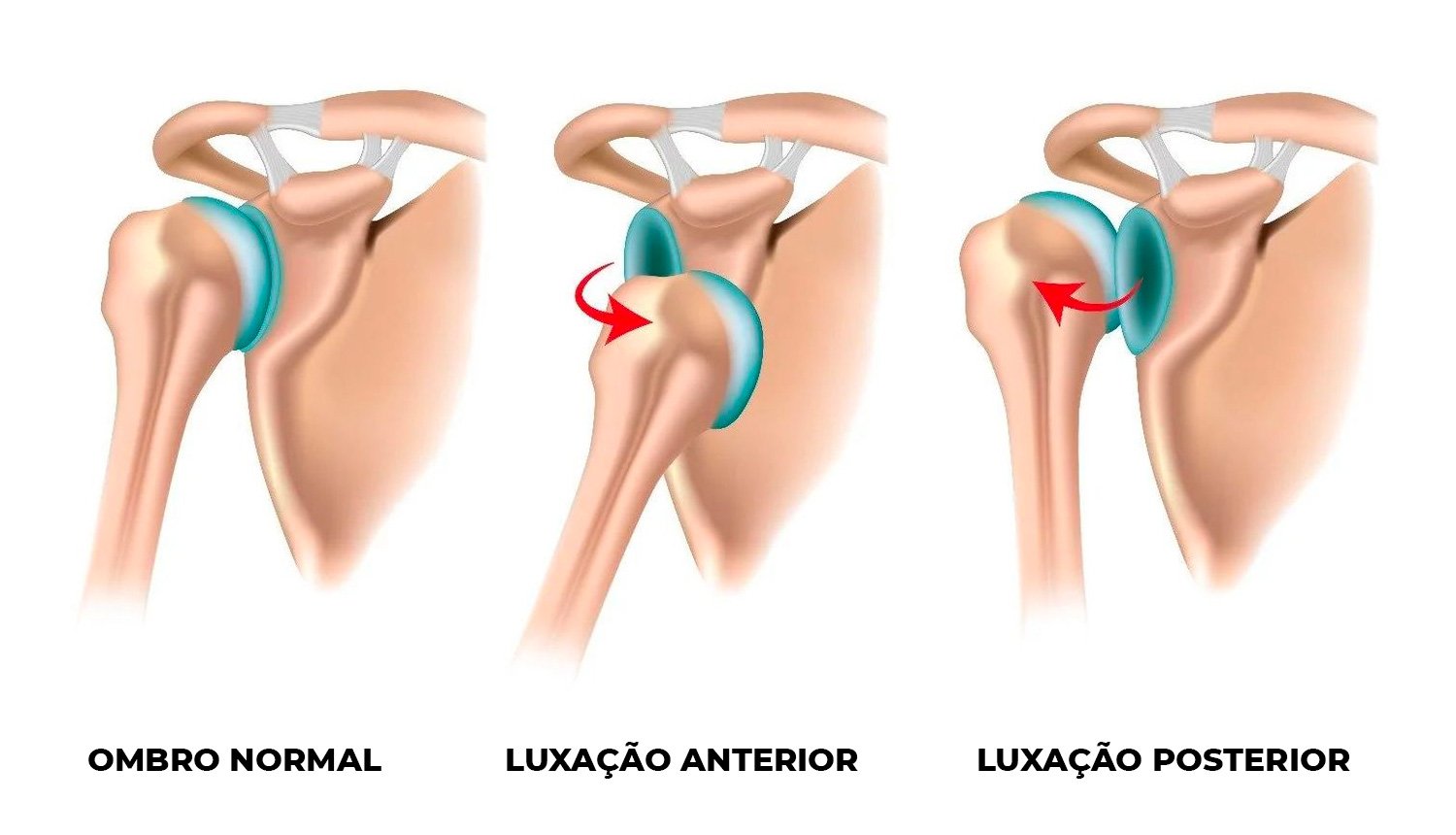 Cirurgia Artroscópica para Luxação Do Ombro