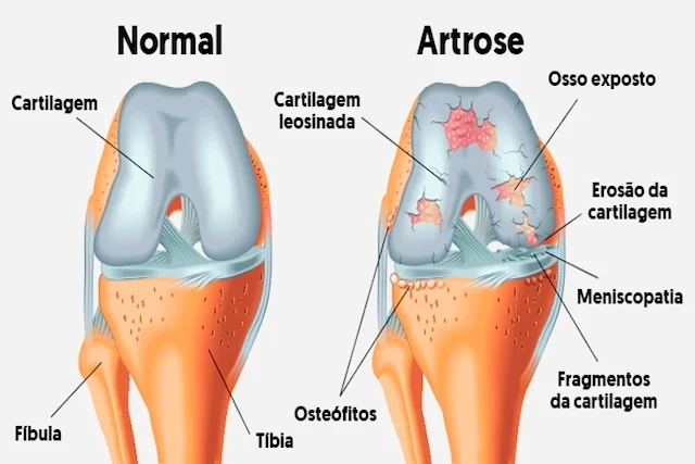 Tratamento para Artrose