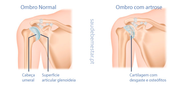 Tratamento para artrose no ombro - 1